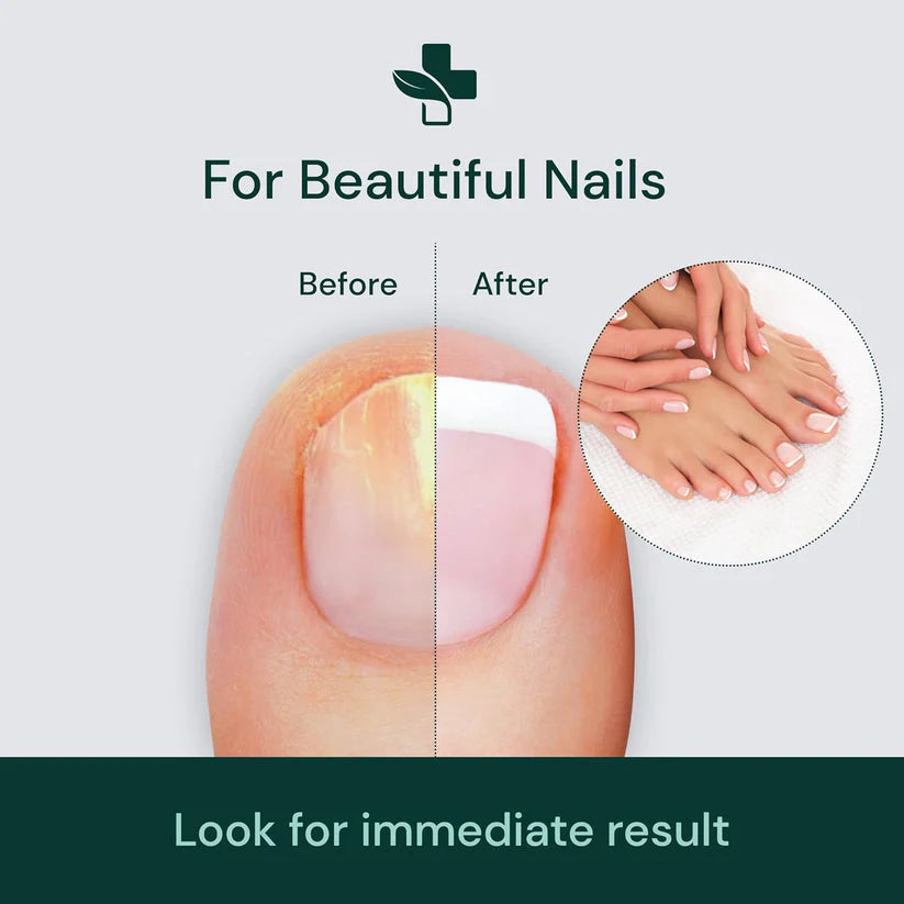 नेल फंगस सीरम - Nail Repair™PACK OF 2