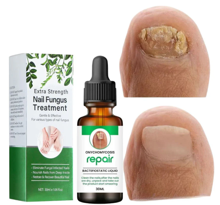 नेल फंगस सीरम - Nail Repair™PACK OF 2